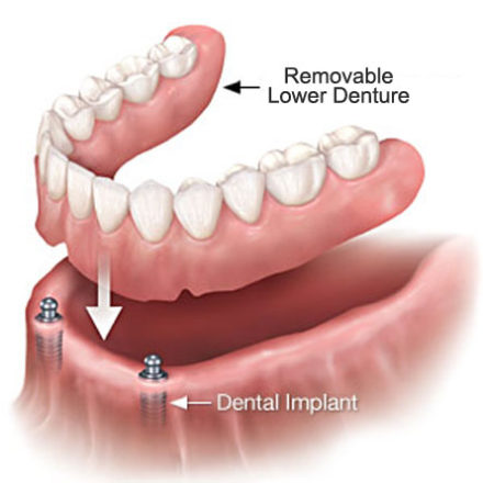 implant supported dentures